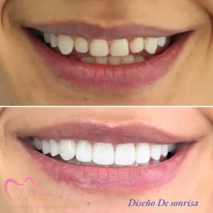 Diseño de Sonrisa - Dra. Yolima Ortiz (1)