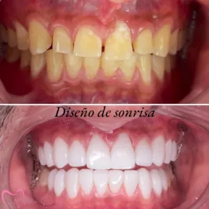 Diseño de Sonrisa - Dra. Yolima Ortiz (3)