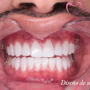 Diseño de Sonrisa - Dra. Yolima Ortiz (5)