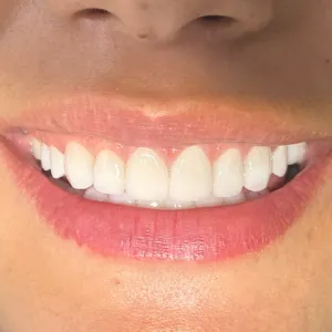 Diseño de Sonrisa - Dra. Yolima Ortiz (6)
