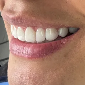 Diseño de Sonrisa - Dra. Yolima Ortiz (8)