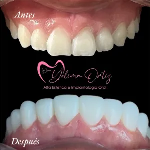 Diseño de Sonrisa - Dra. Yolima Ortiz (9)