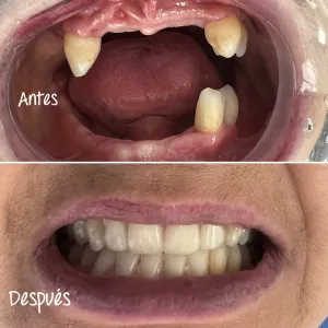 Implantes Dentales - Dra. Yolima Ortiz (1)