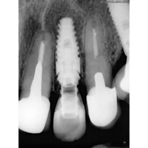 Implantes Dentales - Dra. Yolima Ortiz (2)