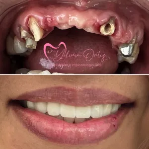 Implantes Dentales - Dra. Yolima Ortiz (3)