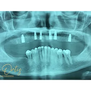 Implantes Dentales - Dra. Yolima Ortiz (4)