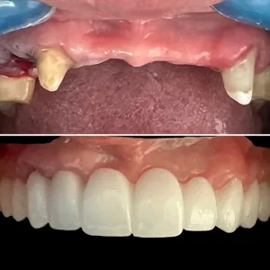 Implantes Dentales - Dra. Yolima Ortiz (5)
