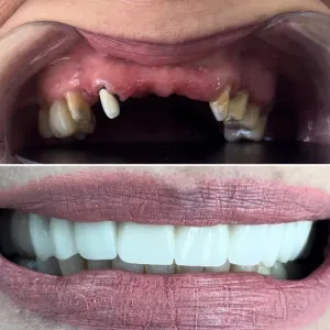 Implantes Dentales - Dra. Yolima Ortiz (6)