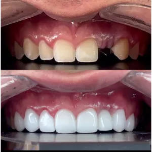 Implantes Dentales - Dra. Yolima Ortiz (7)