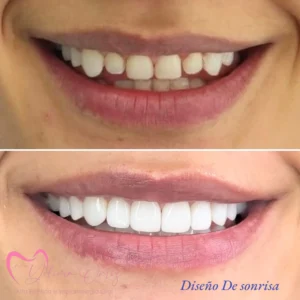 Diseño de Sonrisa - Dra. Yolima Ortiz (2)