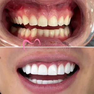 Diseño de sonrisa bogotá Dra. Yolima Ortiz
