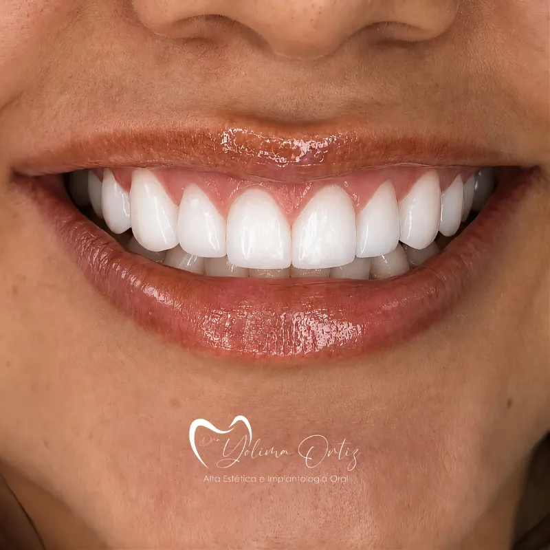 Diseño de sonrisa bogotá Dra. Yolima Ortiz