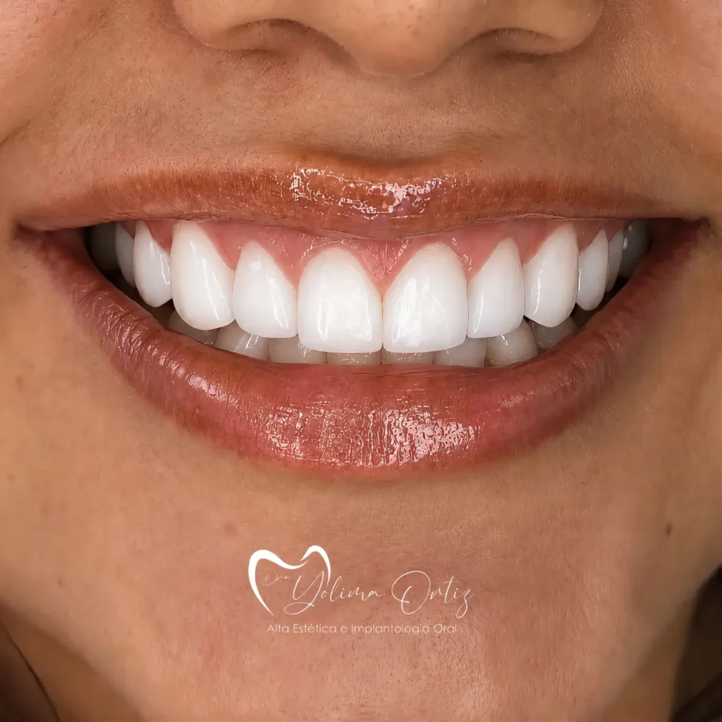 Diseño de sonrisa bogotá Dra. Yolima Ortiz