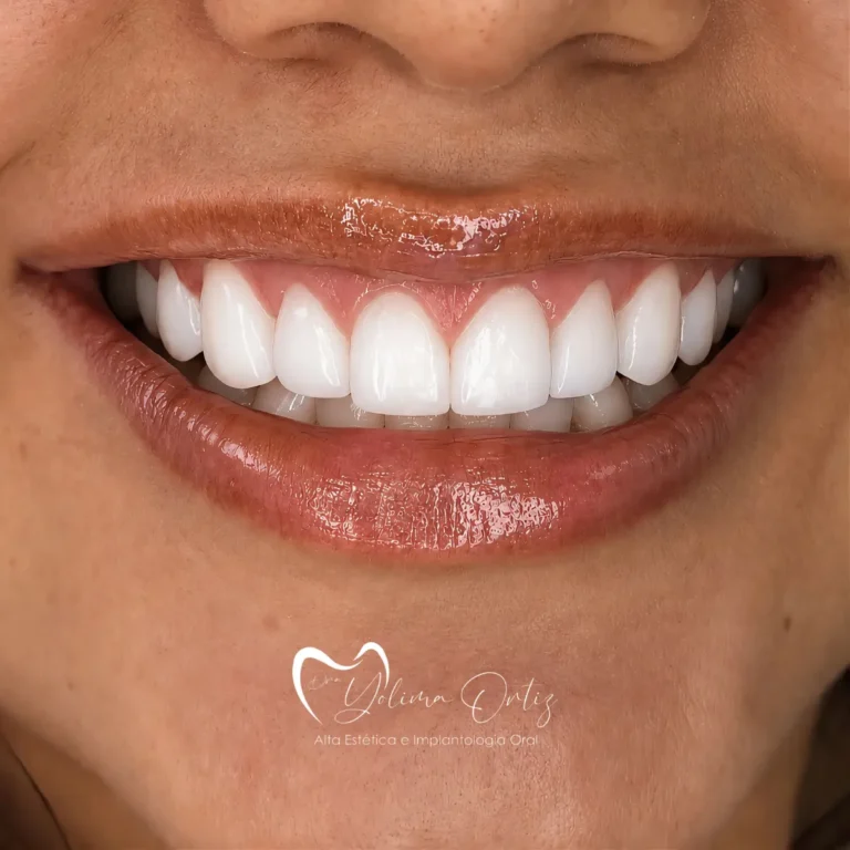 Diseño de sonrisa bogotá Dra. Yolima Ortiz