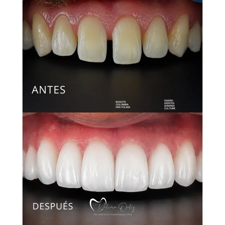 Diseño de sonrisa bogotá Dra. Yolima Ortiz