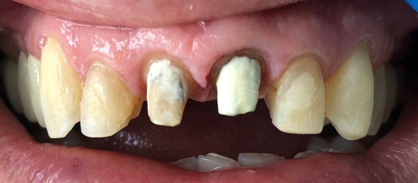 implantes dentales Bogota - Dra. Yolima Ortiz