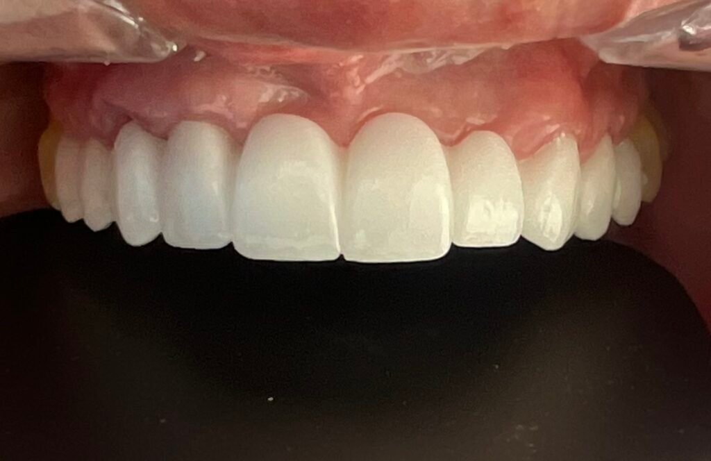implantes dentales Bogota - Dra. Yolima Ortiz