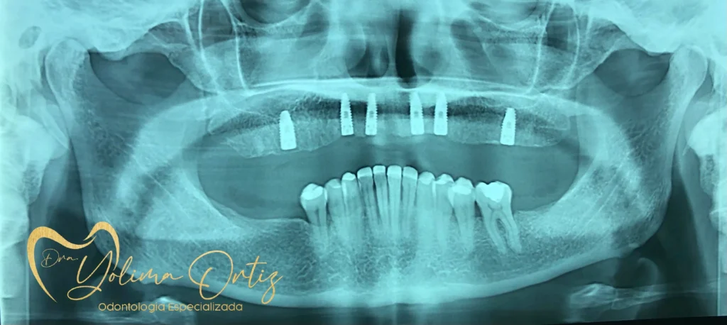 implantes dentales Bogota - Dra. Yolima Ortiz