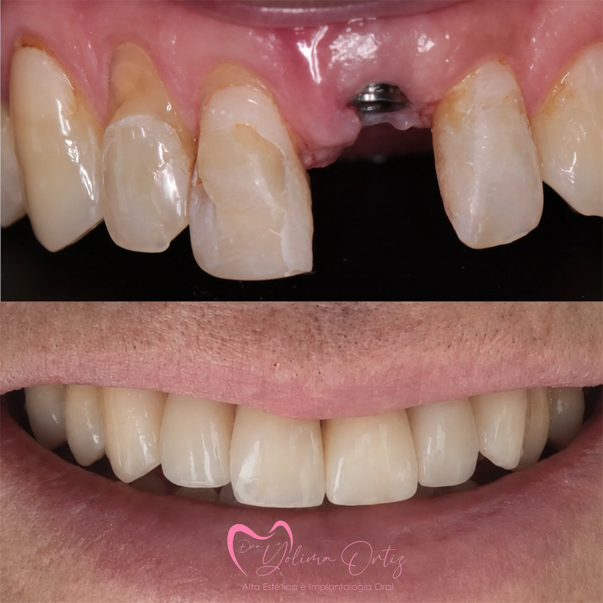 Implantes Dentales - Dra. Yolima Ortiz Implantes Dentales - Dra. Yolima Ortiz