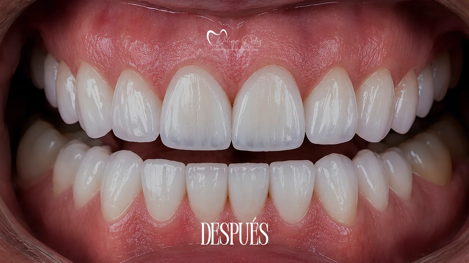 Diseño de Sonrisa - Dra. Yolima Ortiz